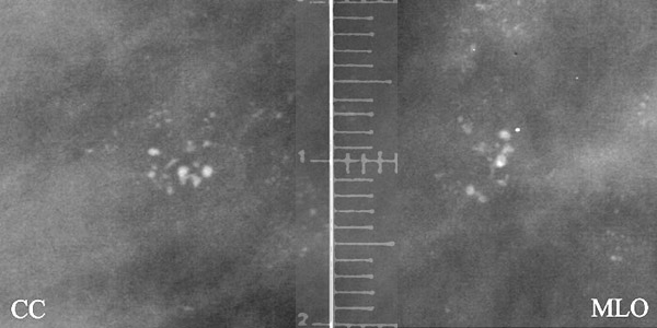 Definition of pleomorphic breast calcifications