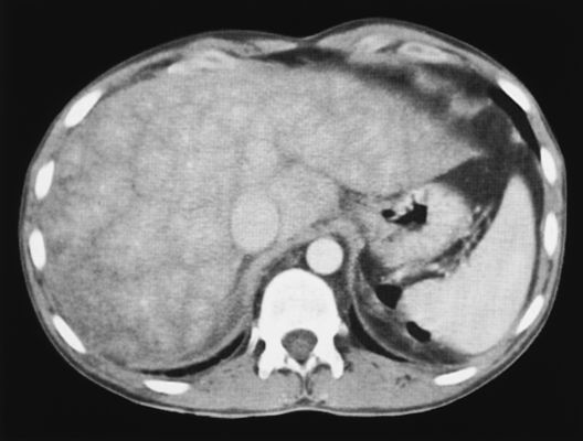 Mosaic Pattern Liver Ct | eurorad radiologic teaching files Mosaic Pattern Liver Ct | eurorad radiologic teaching files