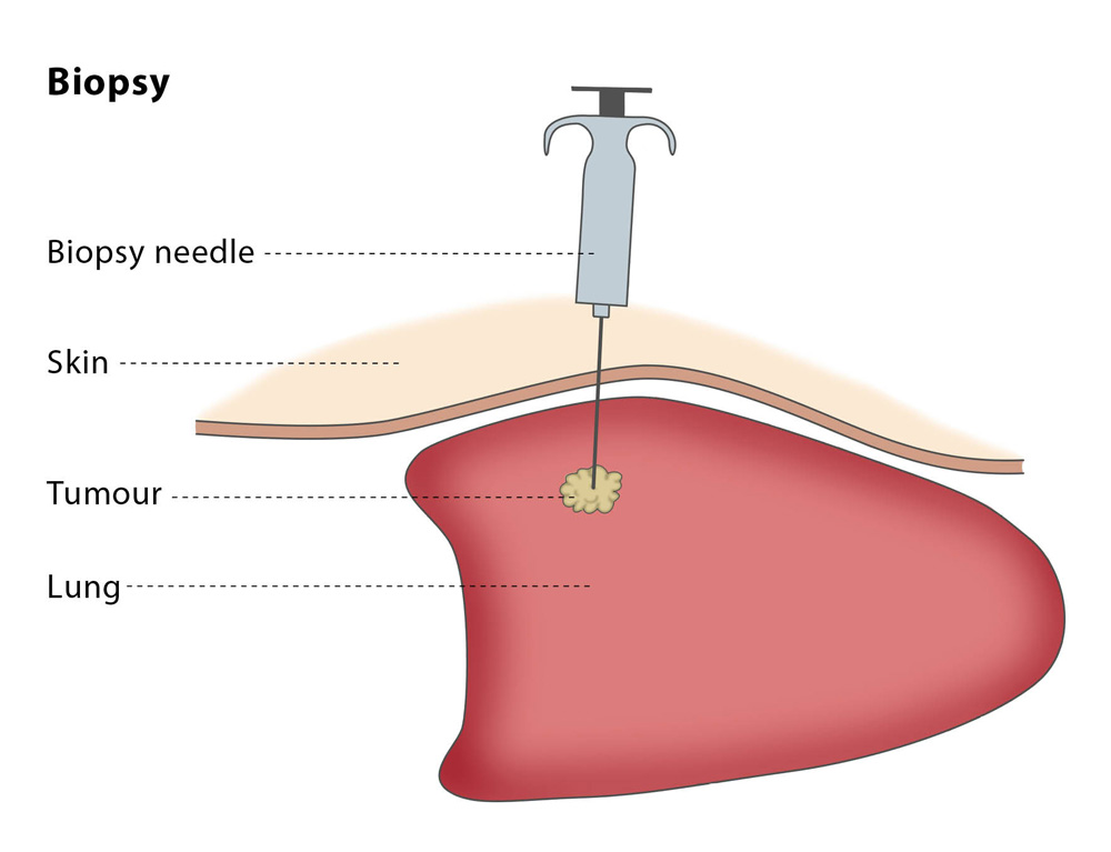 Image result for biopsy