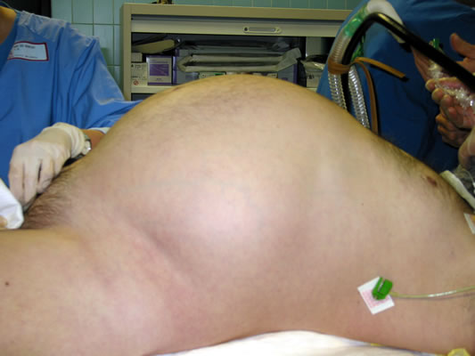 What is abdominal distension