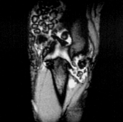 Analgezice pentru osteochondroza coloanei vertebrale toracice
